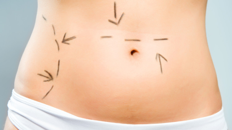 Closeup photo of a Caucasian lady's abdomen  marked with lines for abdominal cellulite correction cosmetic surgery